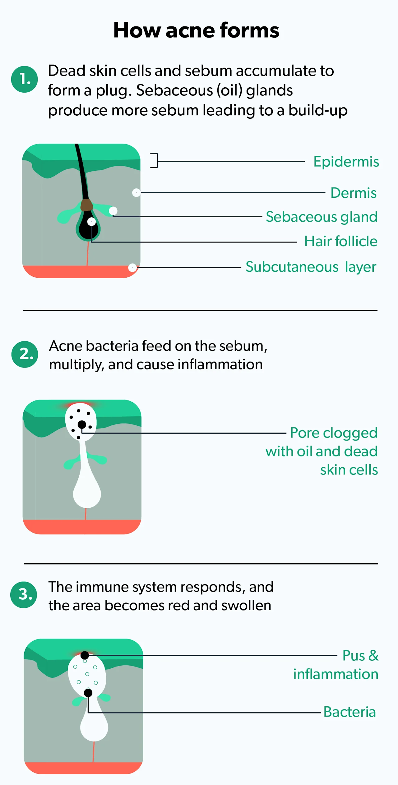 OC Types of acne treatments image bd117532-32ff-4fd8-aca4-1b110ef84974
