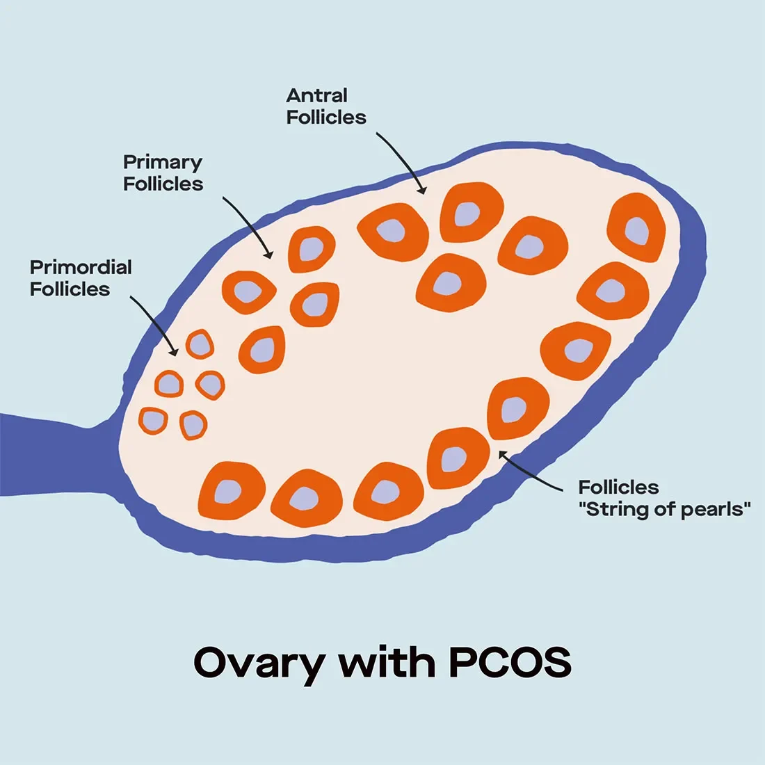 OC PCOS: How hormone tests can help with diagnosis image c89eb7a3-e709-4499-9ff3-bdd238ecbe64