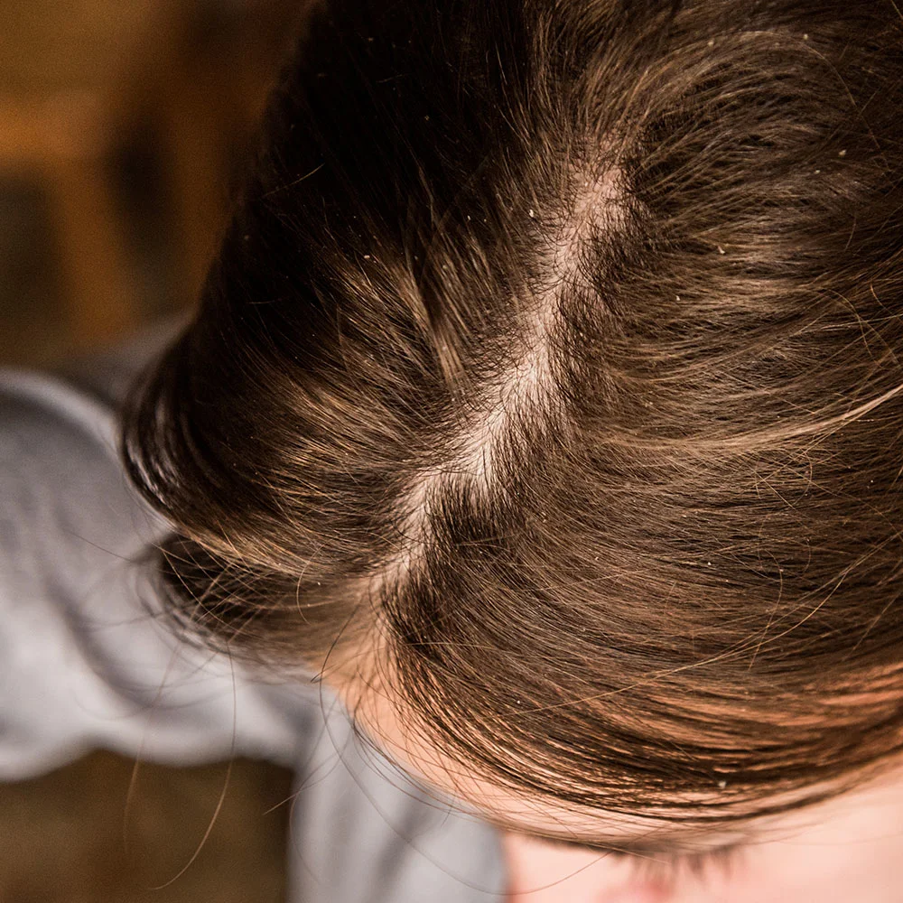 How to get rid of dandruff according to research - Desktop Image