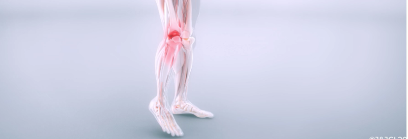 Graphic depicting osteoarthritis (OA) pain in the knee.