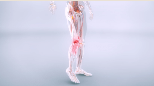 Graphic depicting osteoarthritis (OA) in the knee.