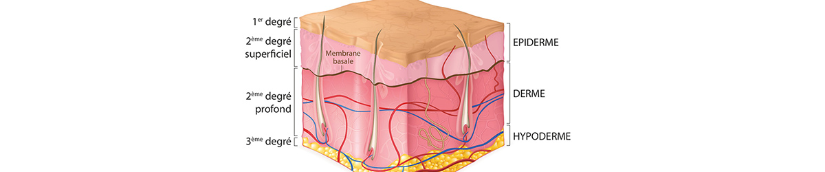 Brûlures du 1er, 2e et 3e degré, coment déterminer la gravité d’une brûlure