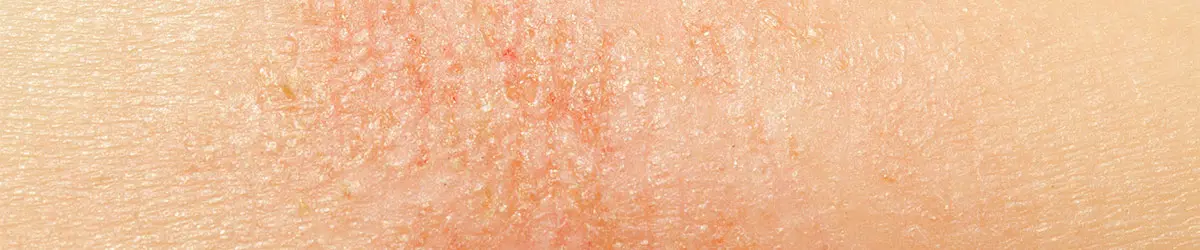 Reconnaître une peau atopique