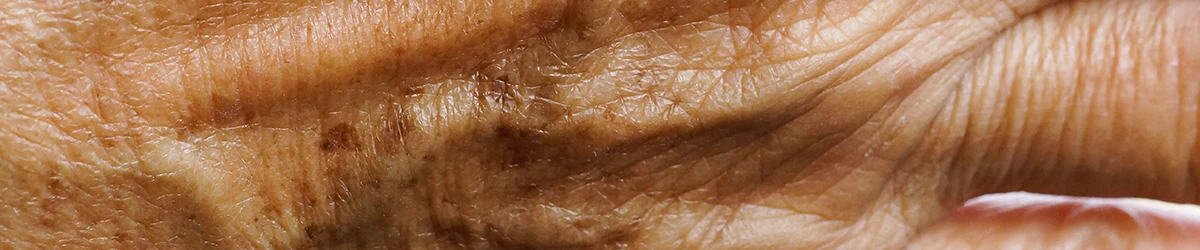 Origine des tâches brunes et comment les réduire