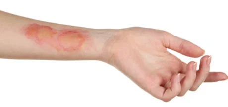 Les différents types de brûlures et comment les identifier