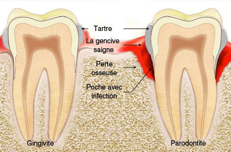 Gingivite et parondite 