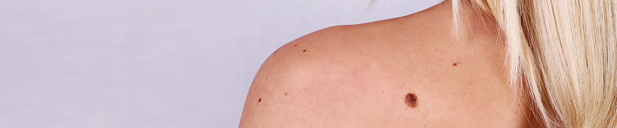 Tout savoir sur les allergies solaires
