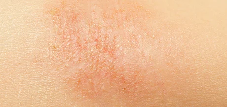 Reconnaître une peau atopique