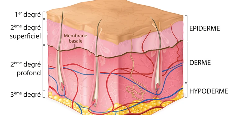 Brûlures du 1er, 2e et 3e degré, coment déterminer la gravité d’une brûlure