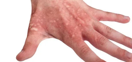 Brûlure et cloque, phlyctène : adoptez les bons gestes pour éviter la surinfection