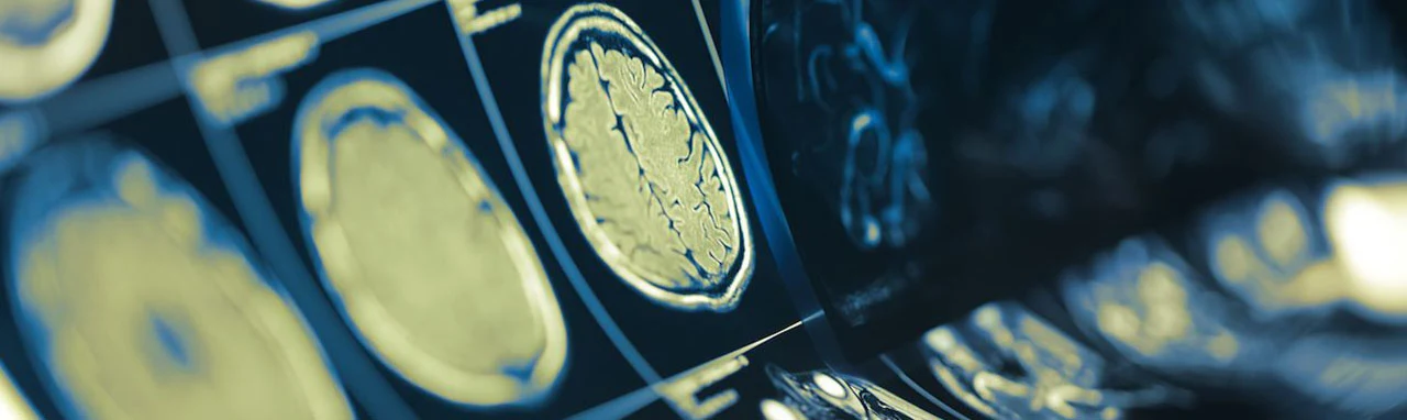 Gros plan sur des radiographies de cerveaux