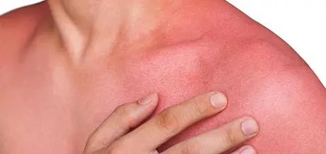 comment soulager le coup de soleil, l’apaiser et le soigner