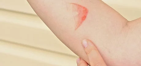 Comment soigner une brûlure superficielle ? Que faire en cas de brûlure superficielle ?