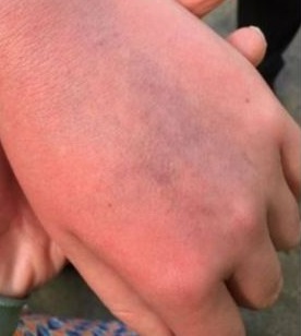 Ręka nastoletniego kibica po ataku Ronaldo
