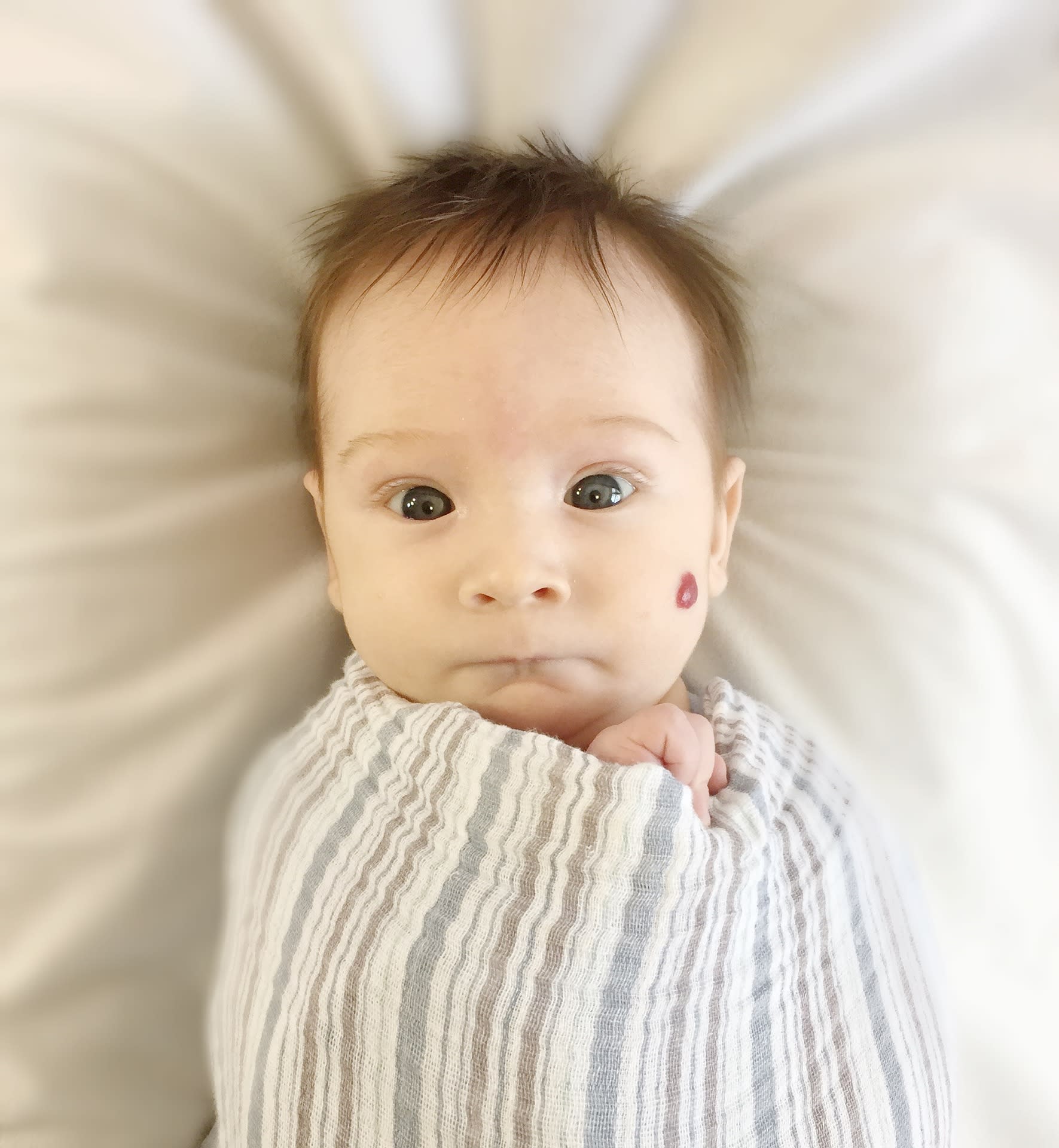 Naczyniak u niemowlaka – czy jest niebezpieczny?