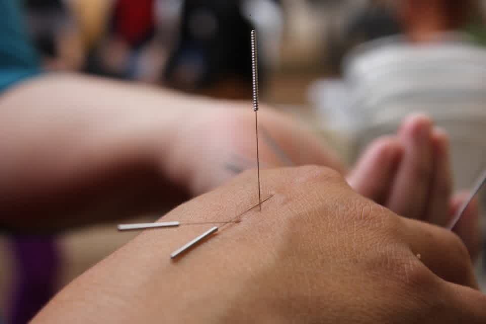 acupuncture primary healthcare