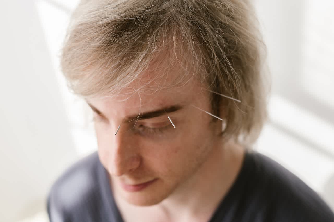 Man undergoing facial acupuncture