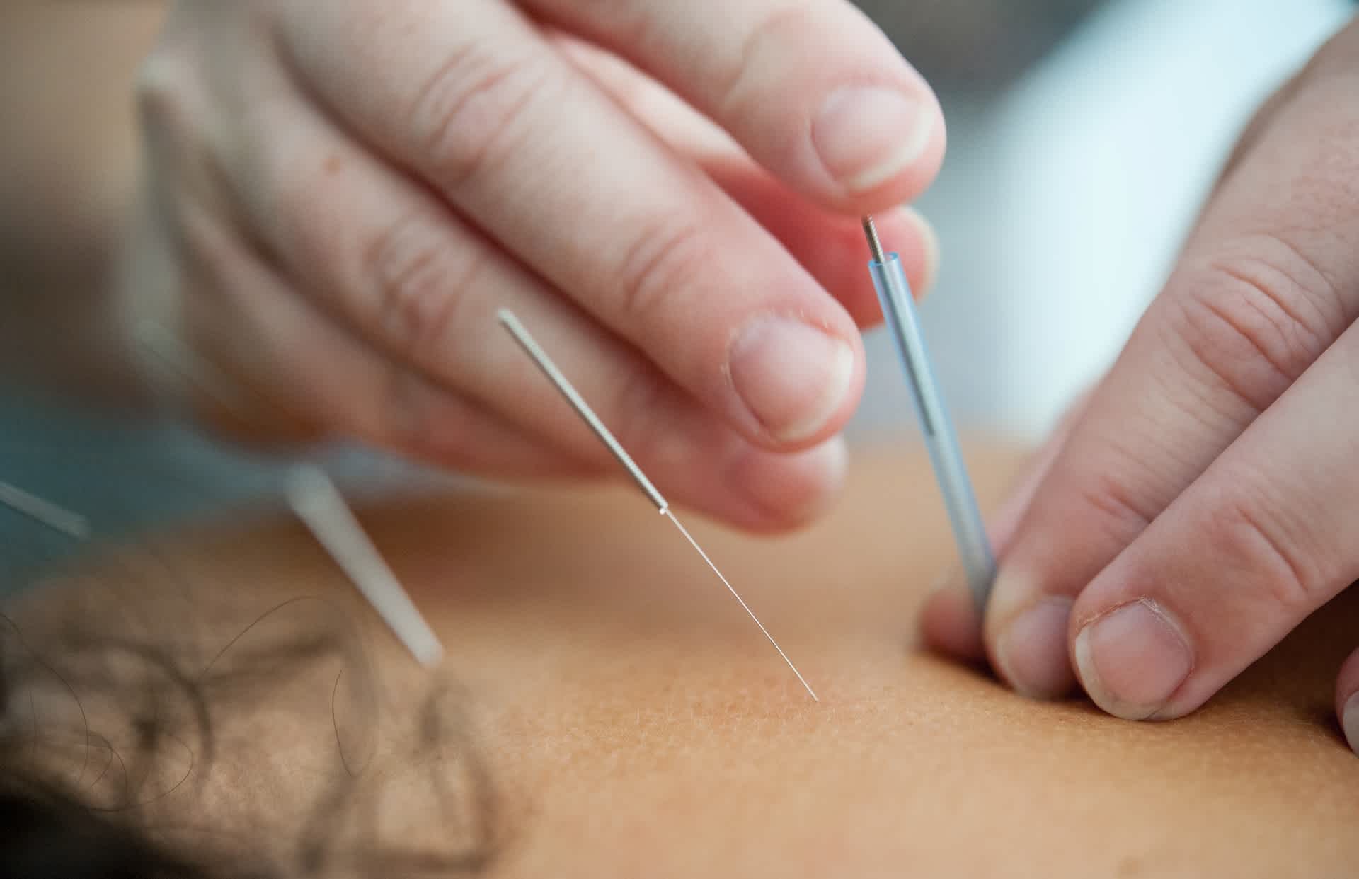 Acupuncture needles being inserted into person's back