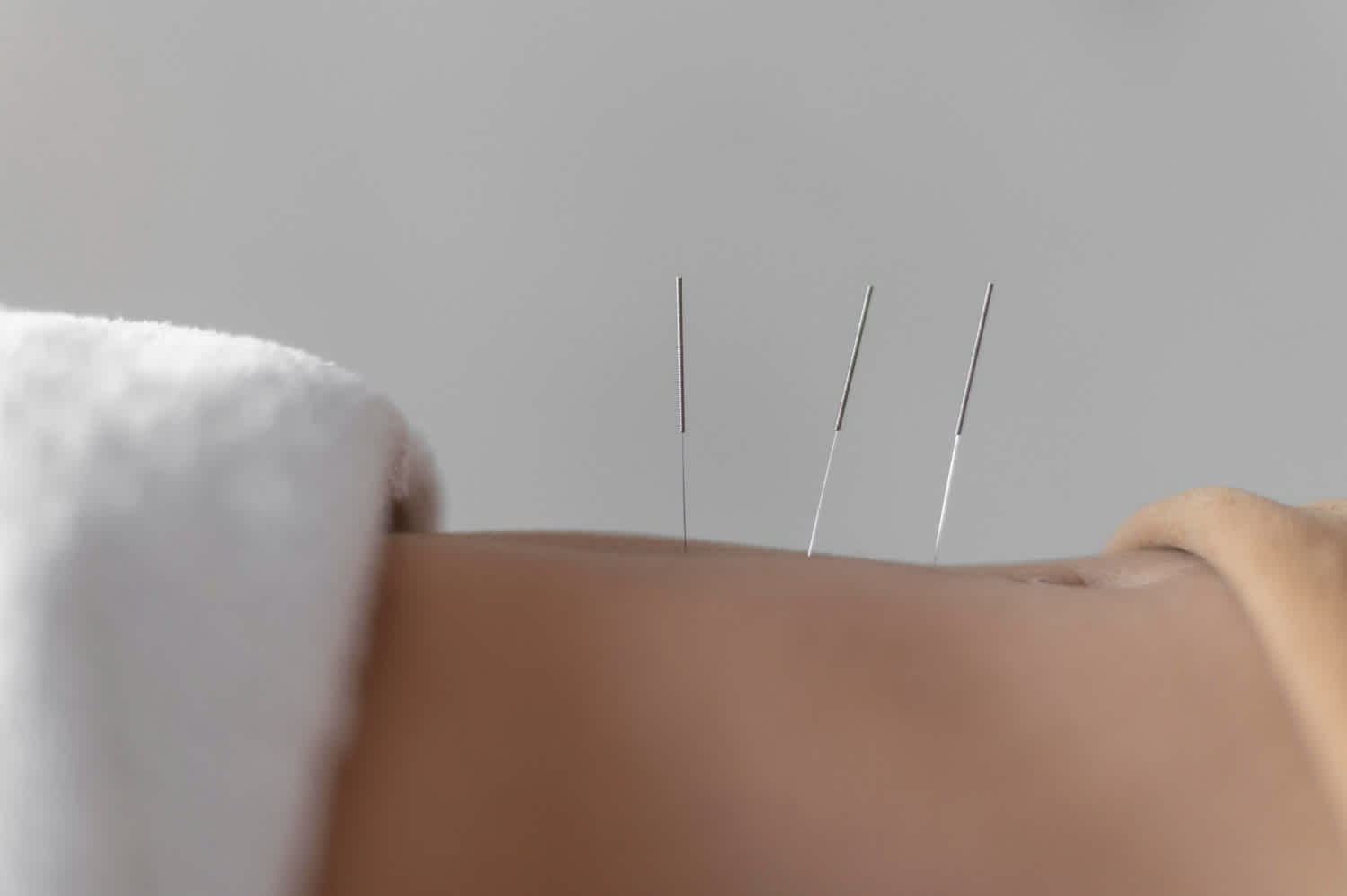 Close up of acupuncture needles on a person's back