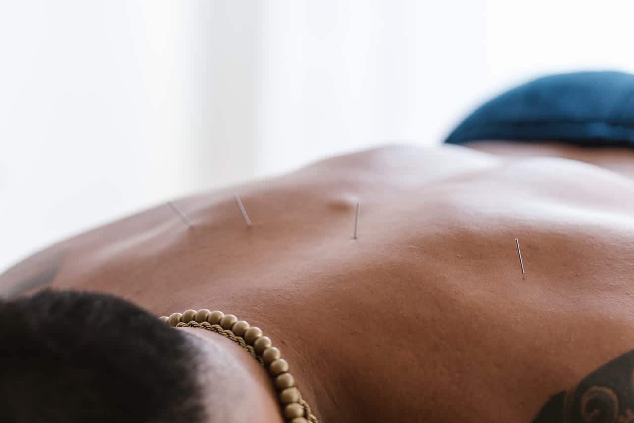 Acupuncture on man's upper back