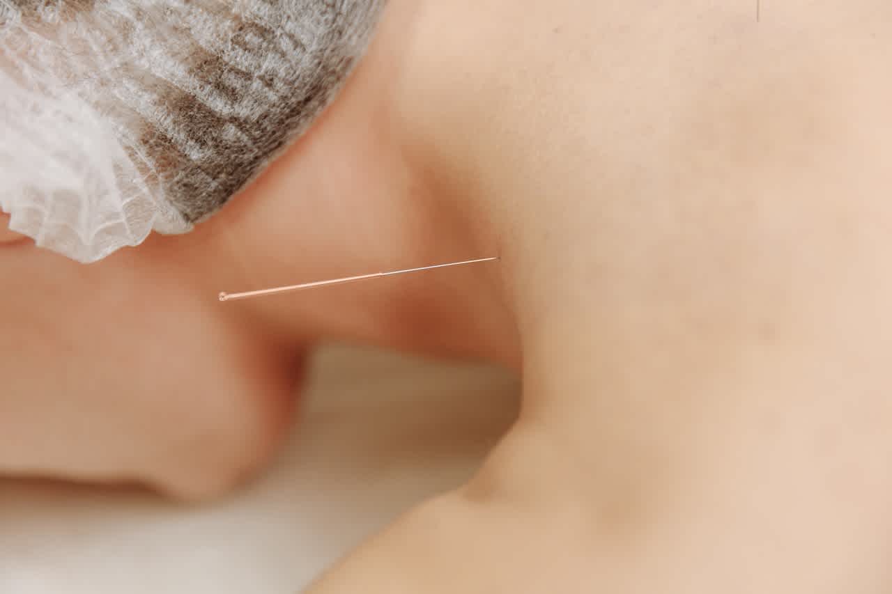 Woman with acupuncture needle in shoulder
