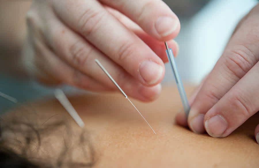 Acupuncturist Inserting Needles Into Back