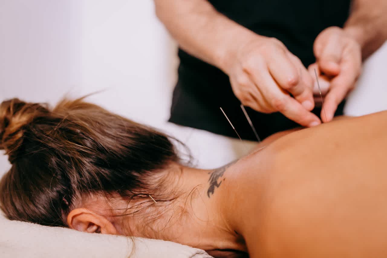 Woman having acupuncture on upper back