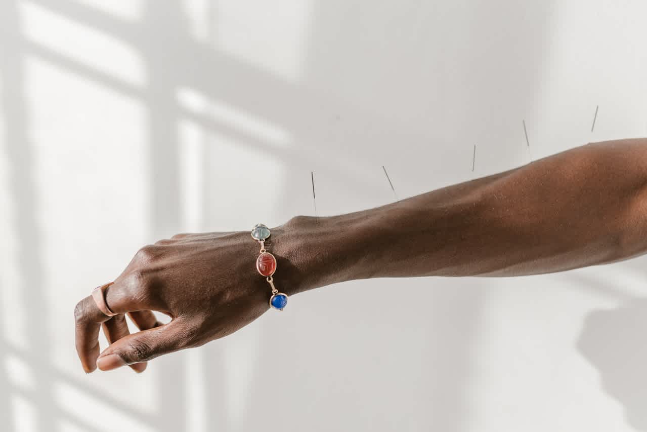 Dry needling on woman's arm