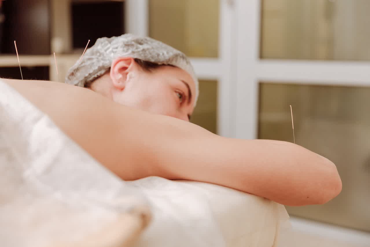 Acupuncture on woman's back and arms