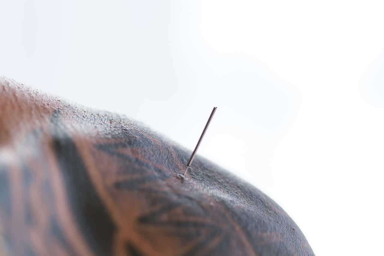 Acupuncture needle on man's shoulder