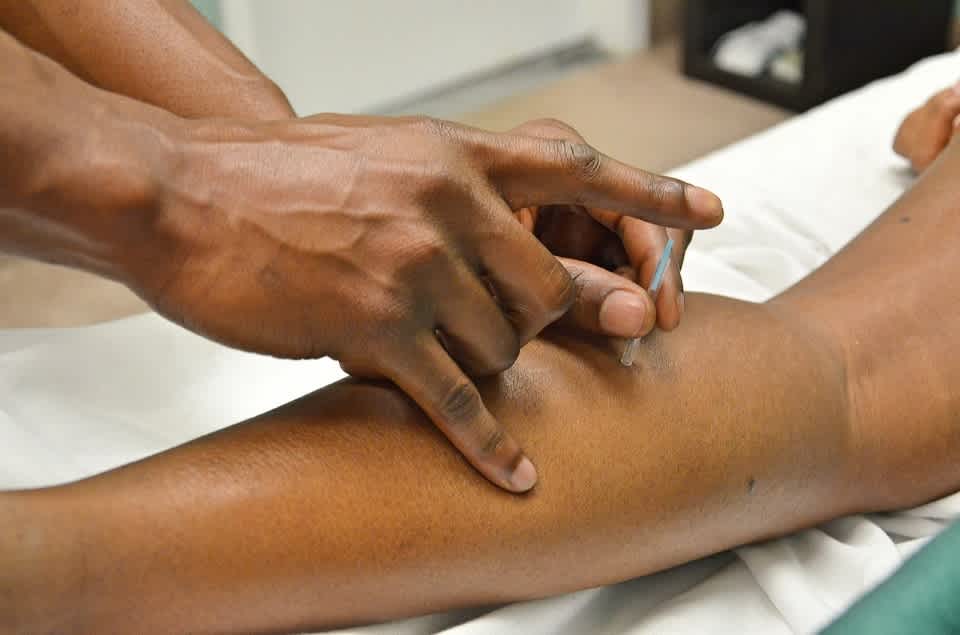 acupuncture for sports injuries