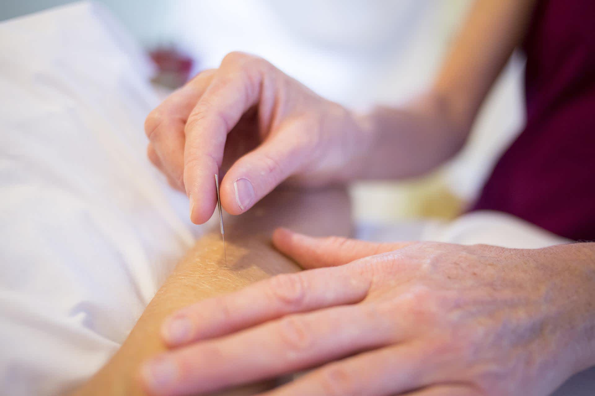 Practitioner giving dry needling