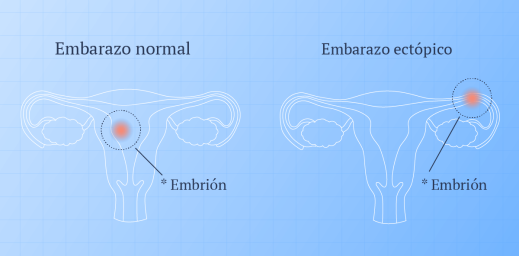 Ilustración de un embarazo normal y de un embarazo ectópico.