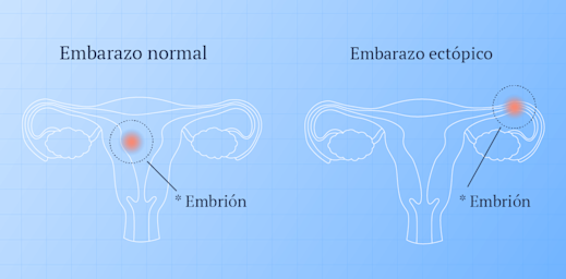 Embarazo Ectopico Ada Embarazo Ectopico Ada