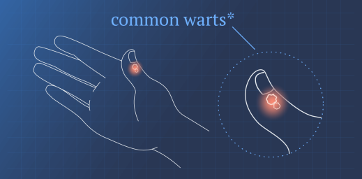 illustration of a hand with common warts on the thumb