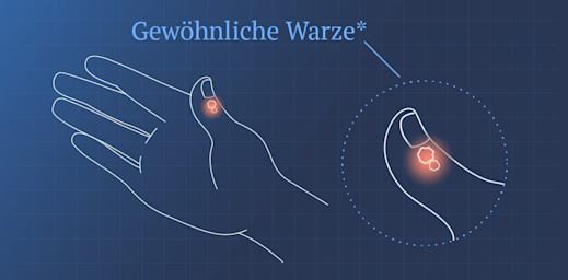 Bild einer Hand mit einer gewöhnlichen Warze am Daumen.
