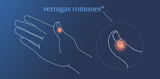 Ilustración de una mano con verrugas comunes en el pulgar.