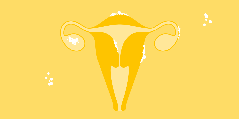 Endometriosis Causas Sintomas Diagnosticos Y Tratamientos