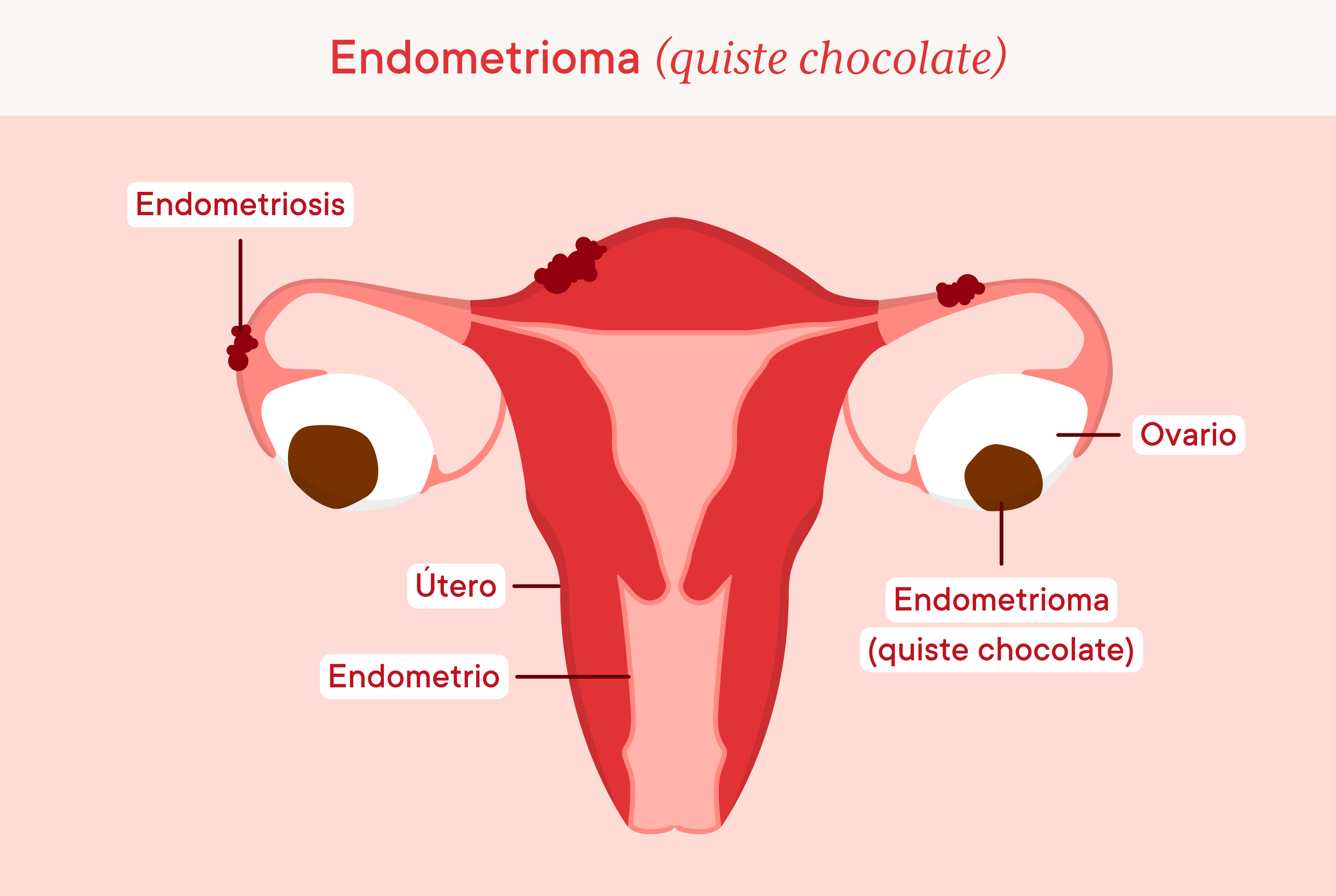 Chocolate cysts, endometrioma on both ovaries 