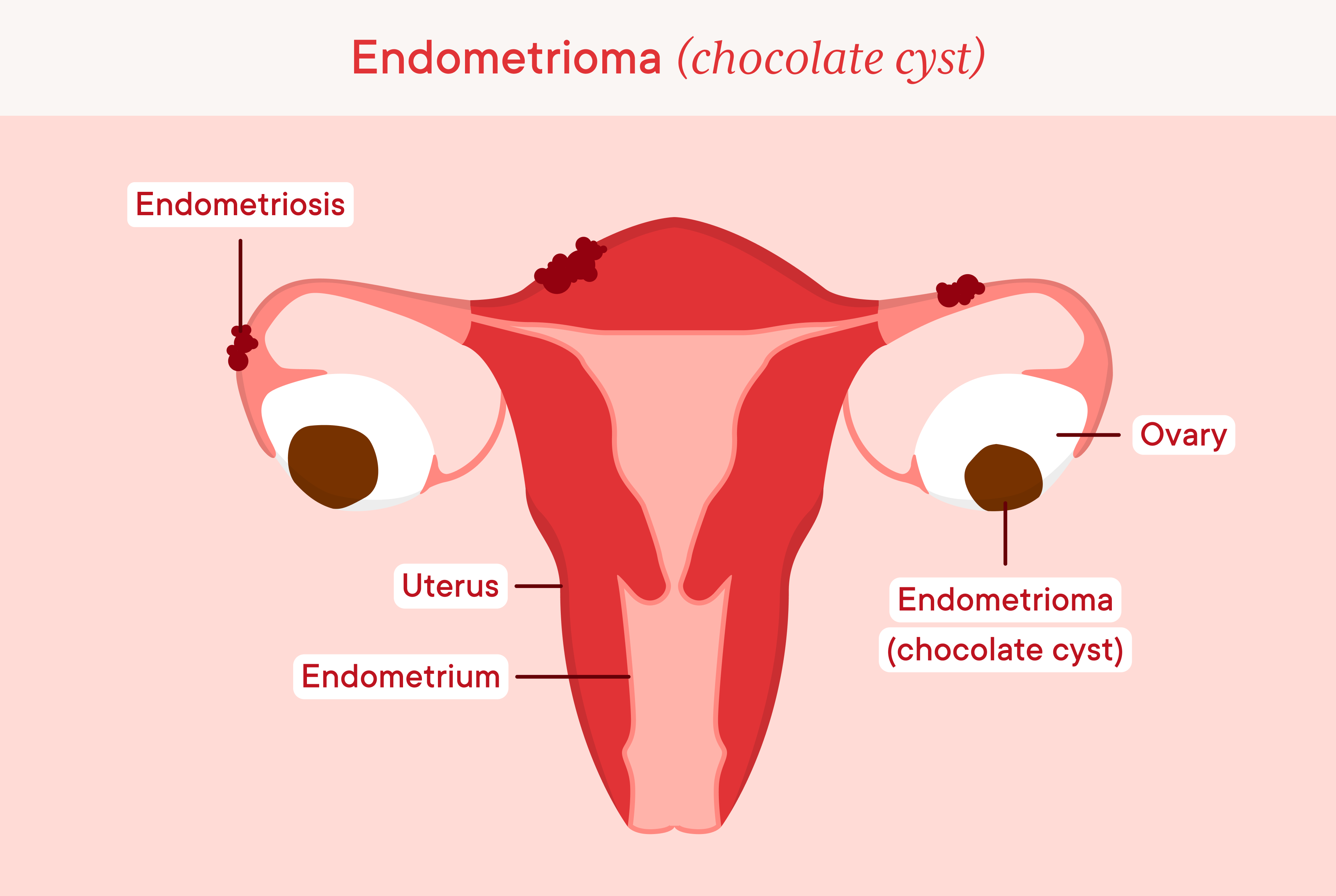 Chocolate cysts, endometrioma on both ovaries 