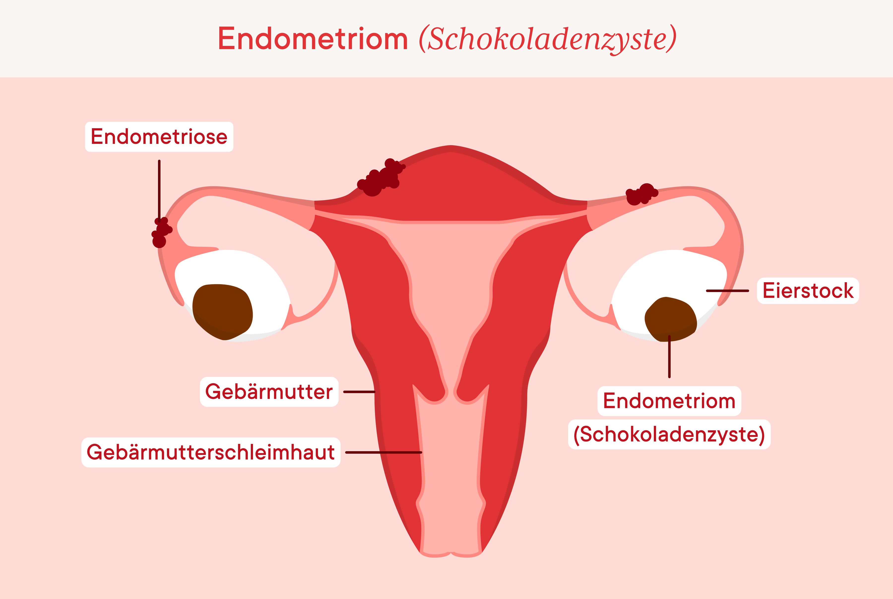Chocolate cysts, endometrioma on both ovaries 