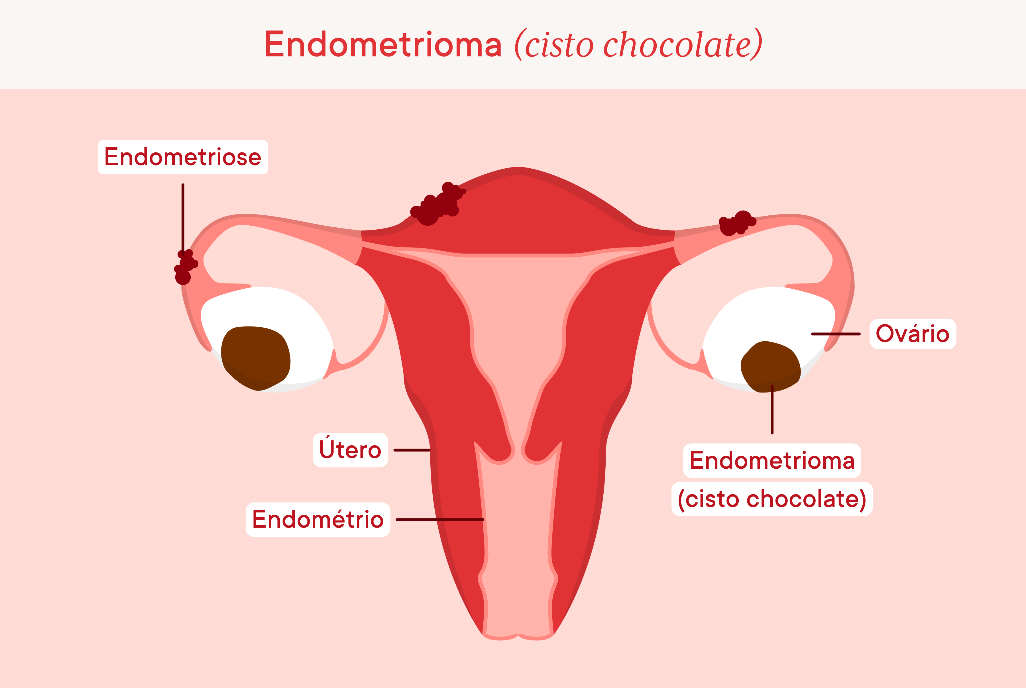 Chocolate cysts, endometrioma on both ovaries 