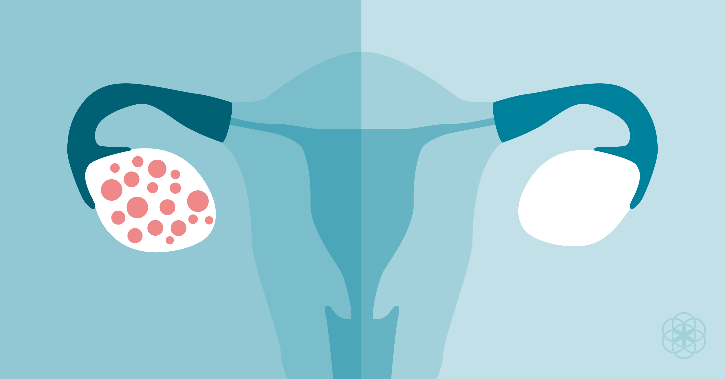 Menstruação irregular e SOP: Como regular?