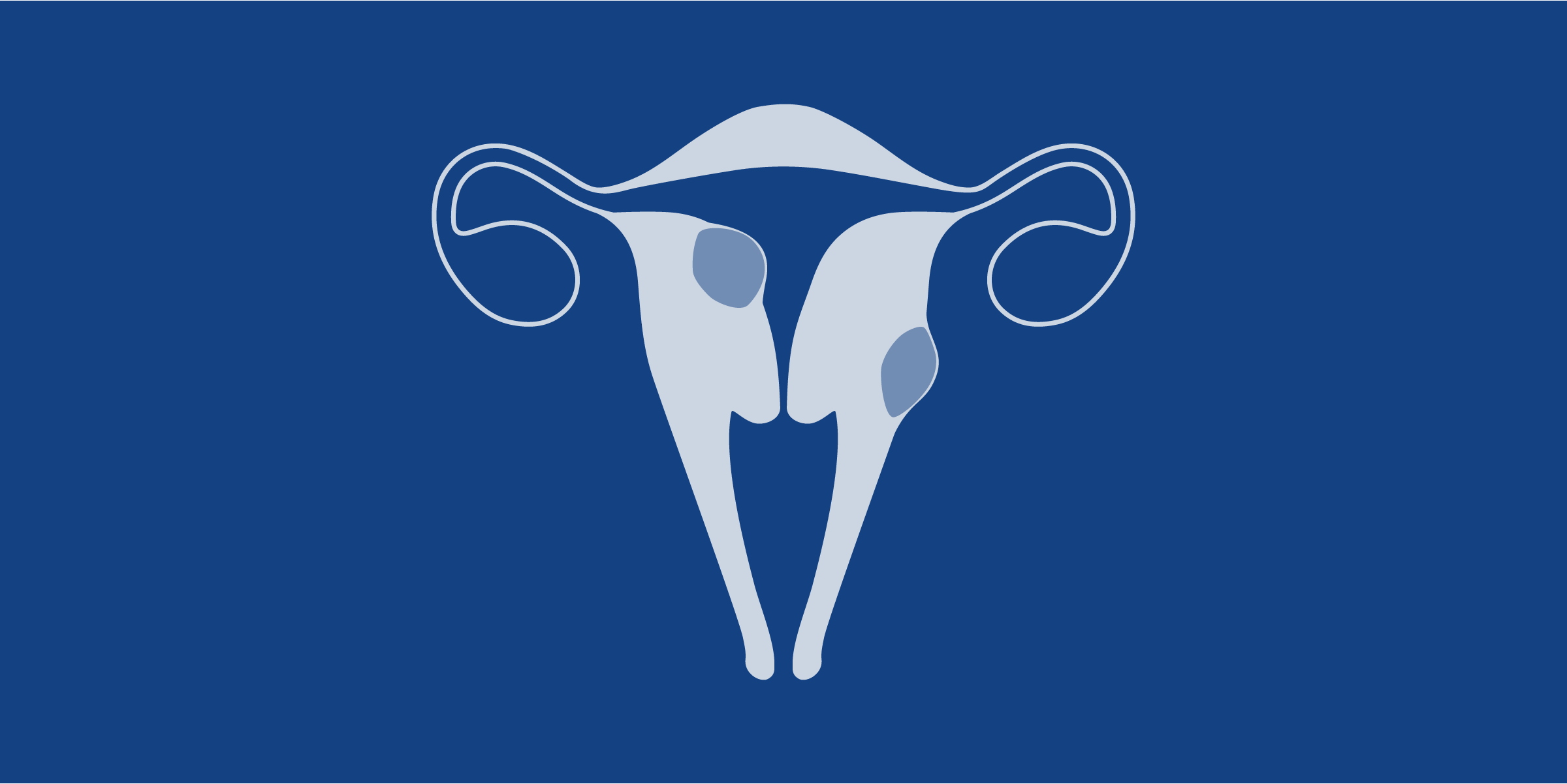 Illustration of an uterus with fibroids