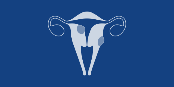Ilustración de un útero con fibromas