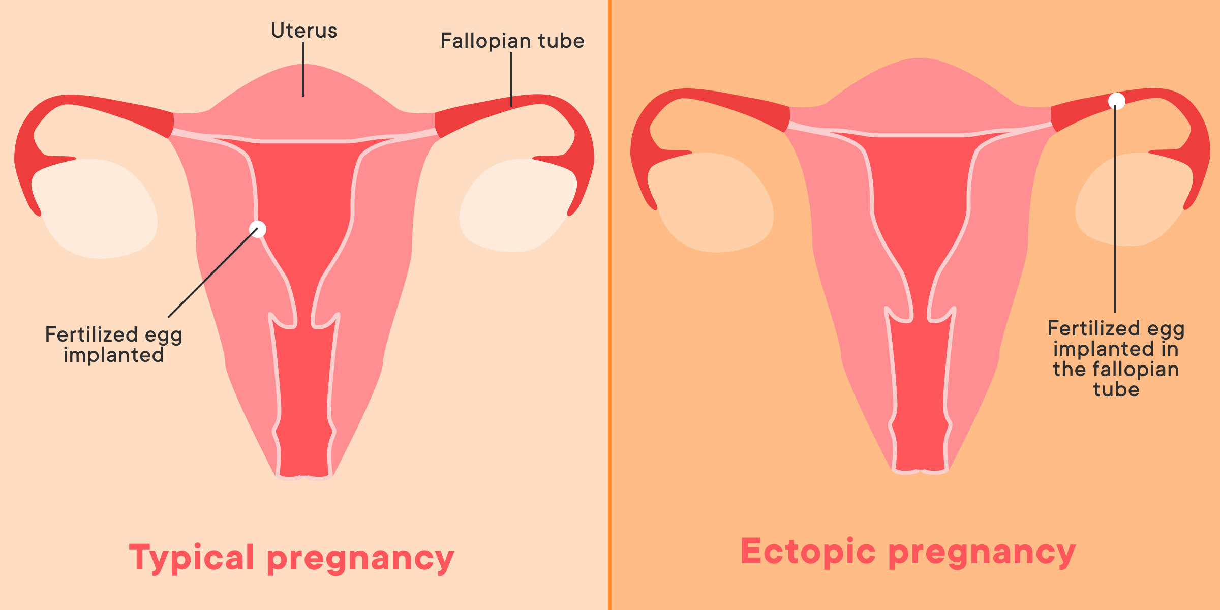 Ectopic pregnancy is rare. Here's what you need to know.
