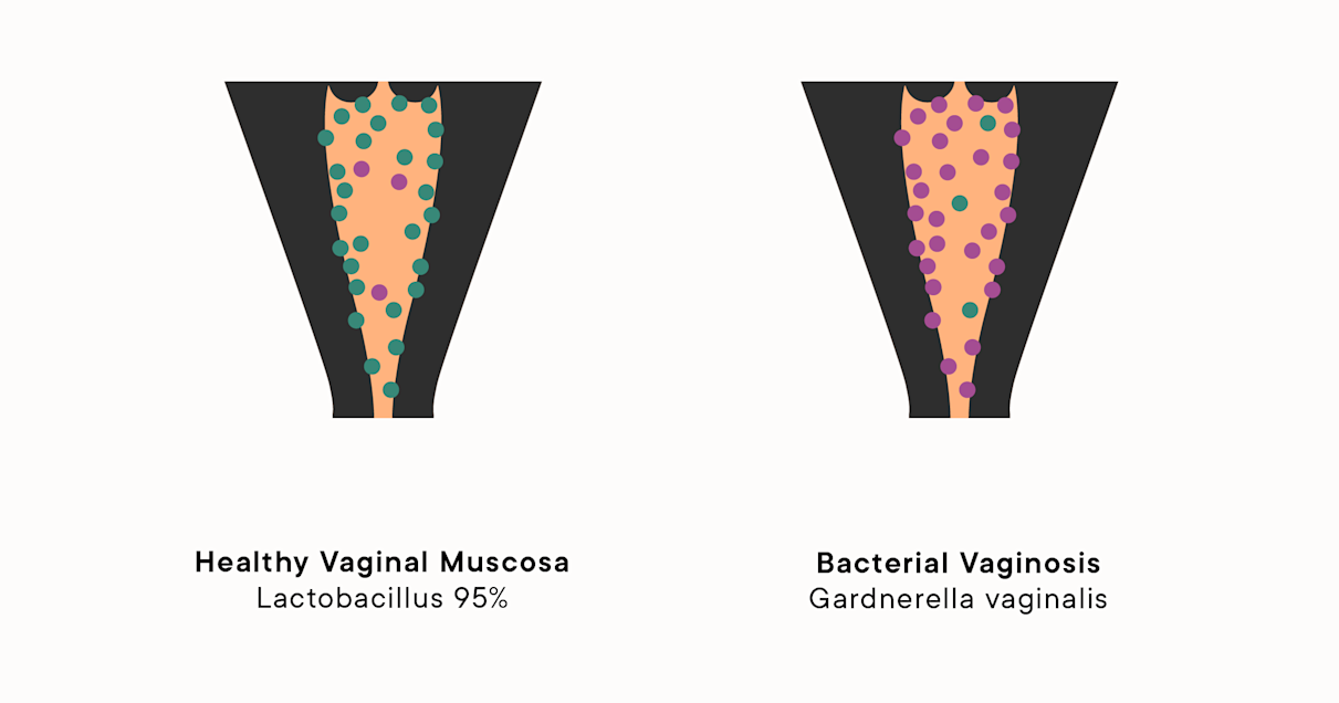 Bacterial Vaginosis and Abnormal Vaginal Discharge: Causes, Symptoms
