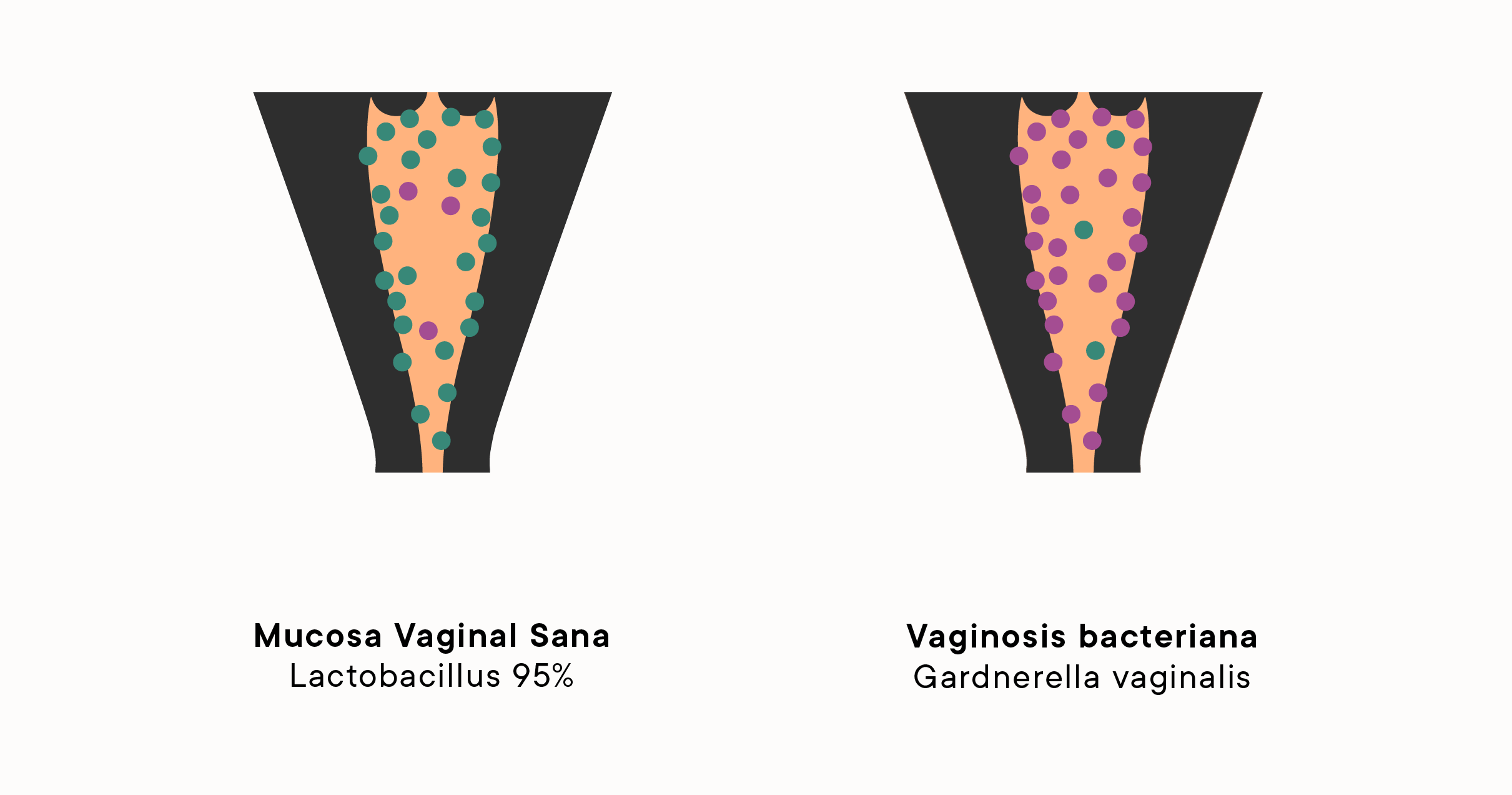 Vaginosis Bacteriana: Razón Común Para El Flujo Vaginal Irregular