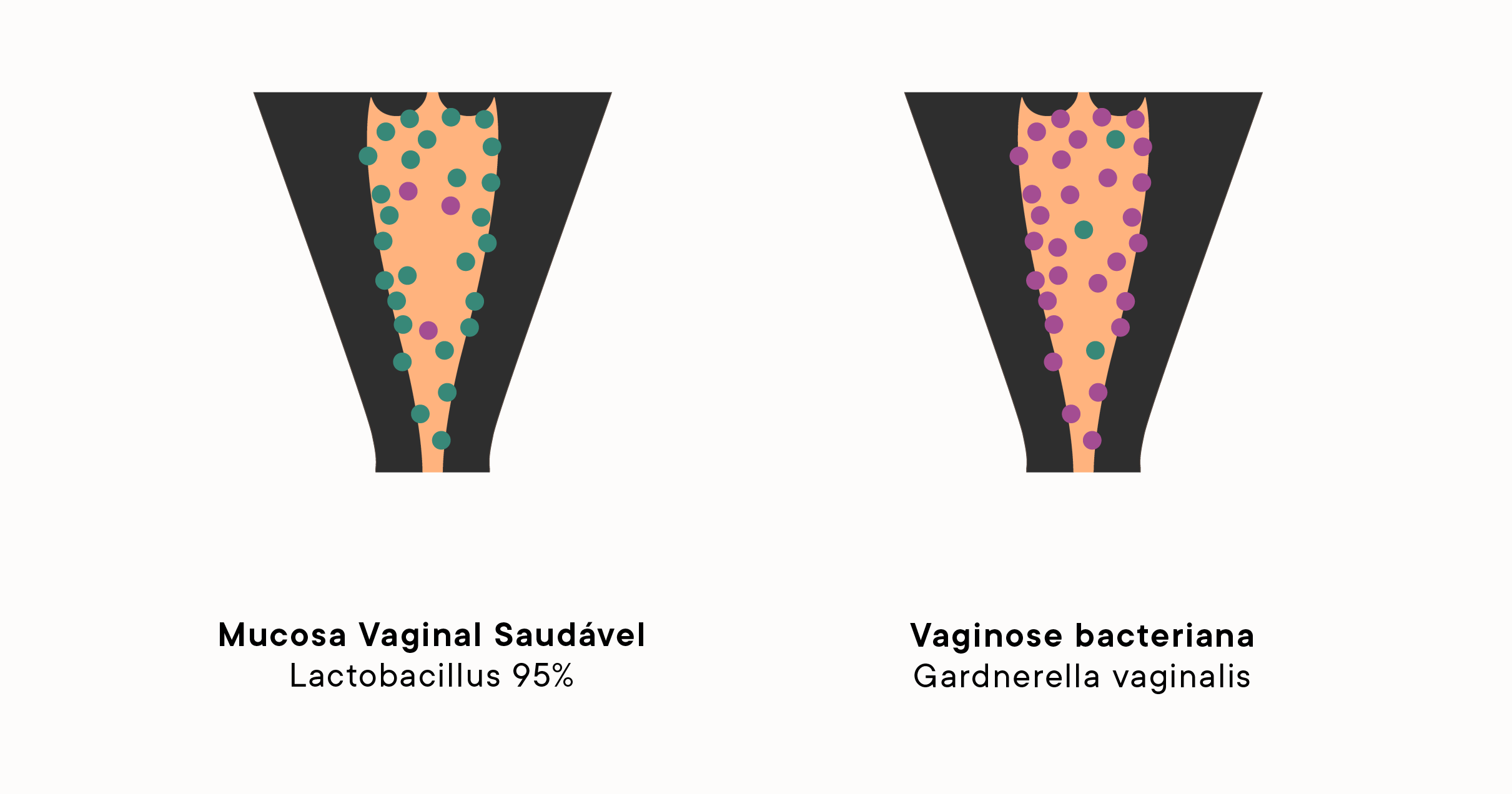 comparative illustration of two vaginal muscoa, one healthy and one with bacterial vaginosis