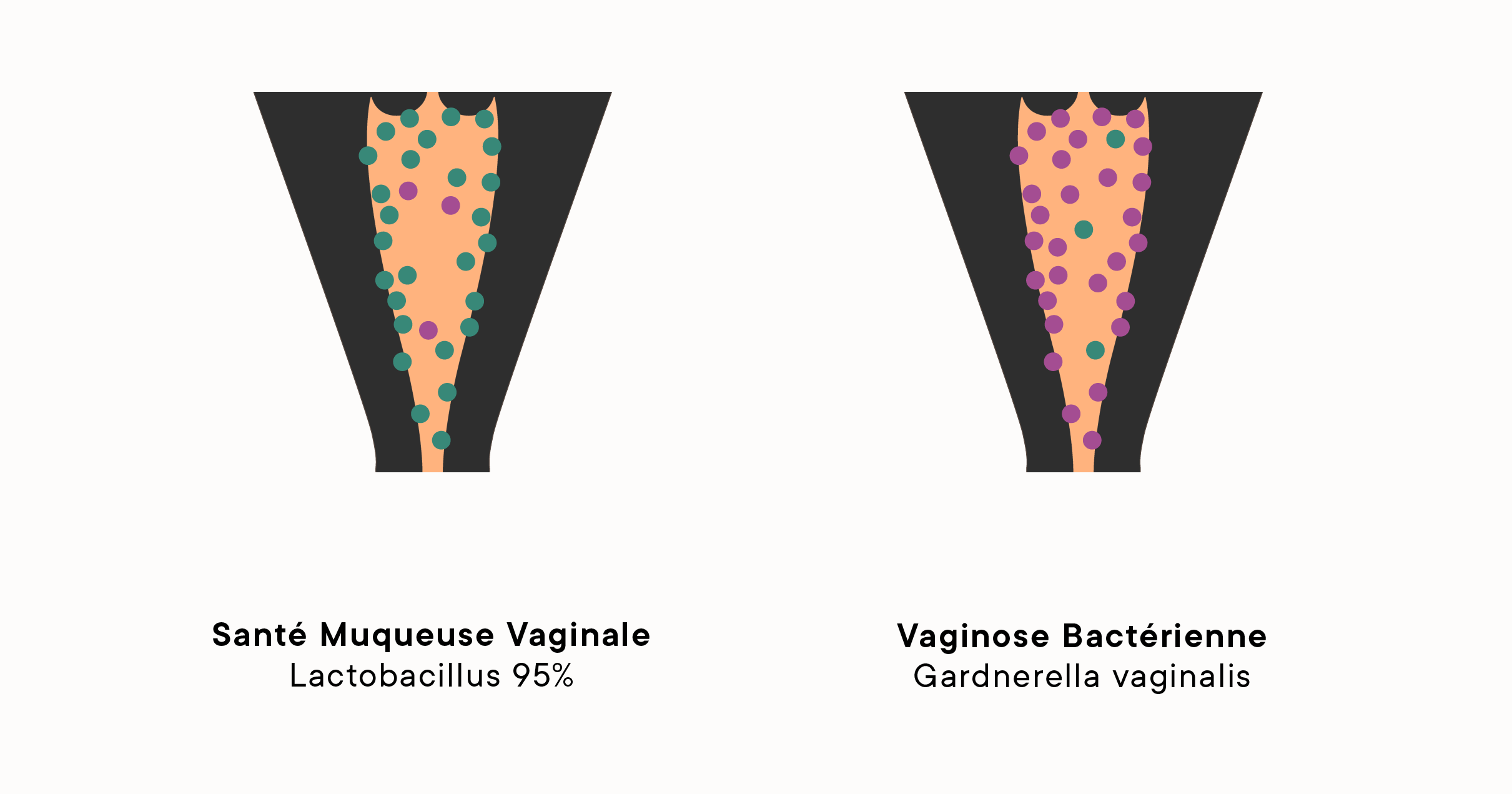 Vaginose Bactérienne : Une Cause Fréquente De Pertes Vaginales Irrégulières